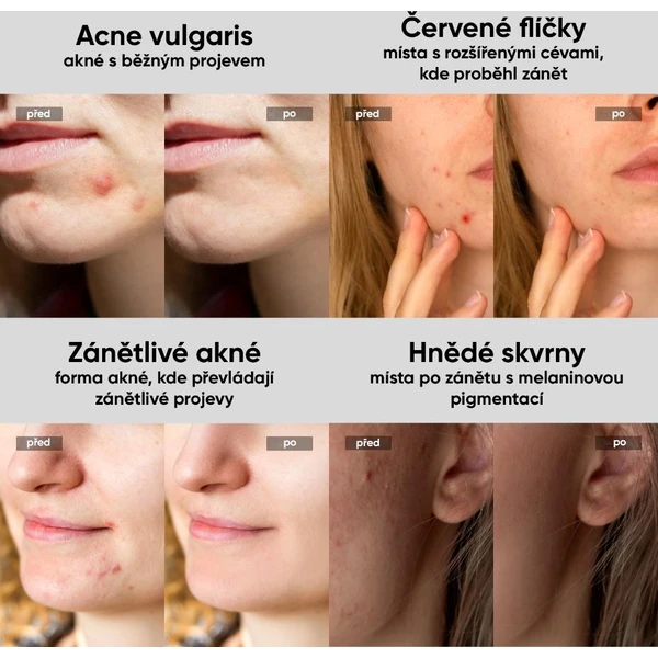 JOVS prístroj na liečbu akné Acneaway - Čističe pleti - Obrázok 78a5187bff134fa0a149d0d73902c31f