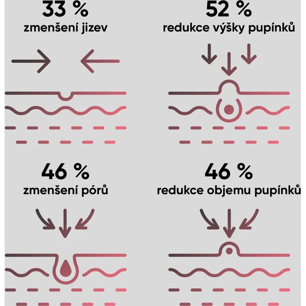 JOVS prístroj na liečbu akné Acneaway - Čističe pleti - Obrázok da819e1fc3334f1690443e3171802840
